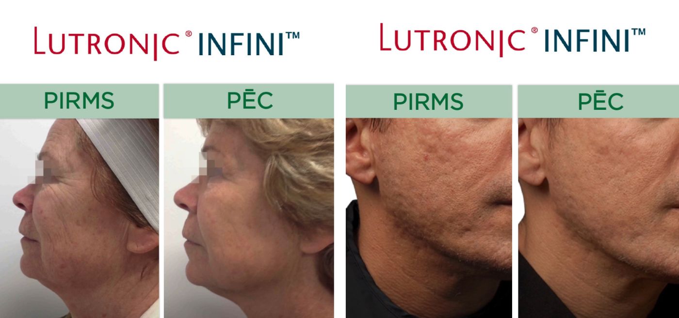 Lutronic Infini